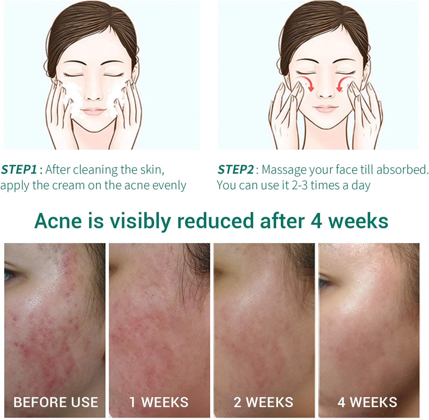 Lanbena Acne Treatment Gel