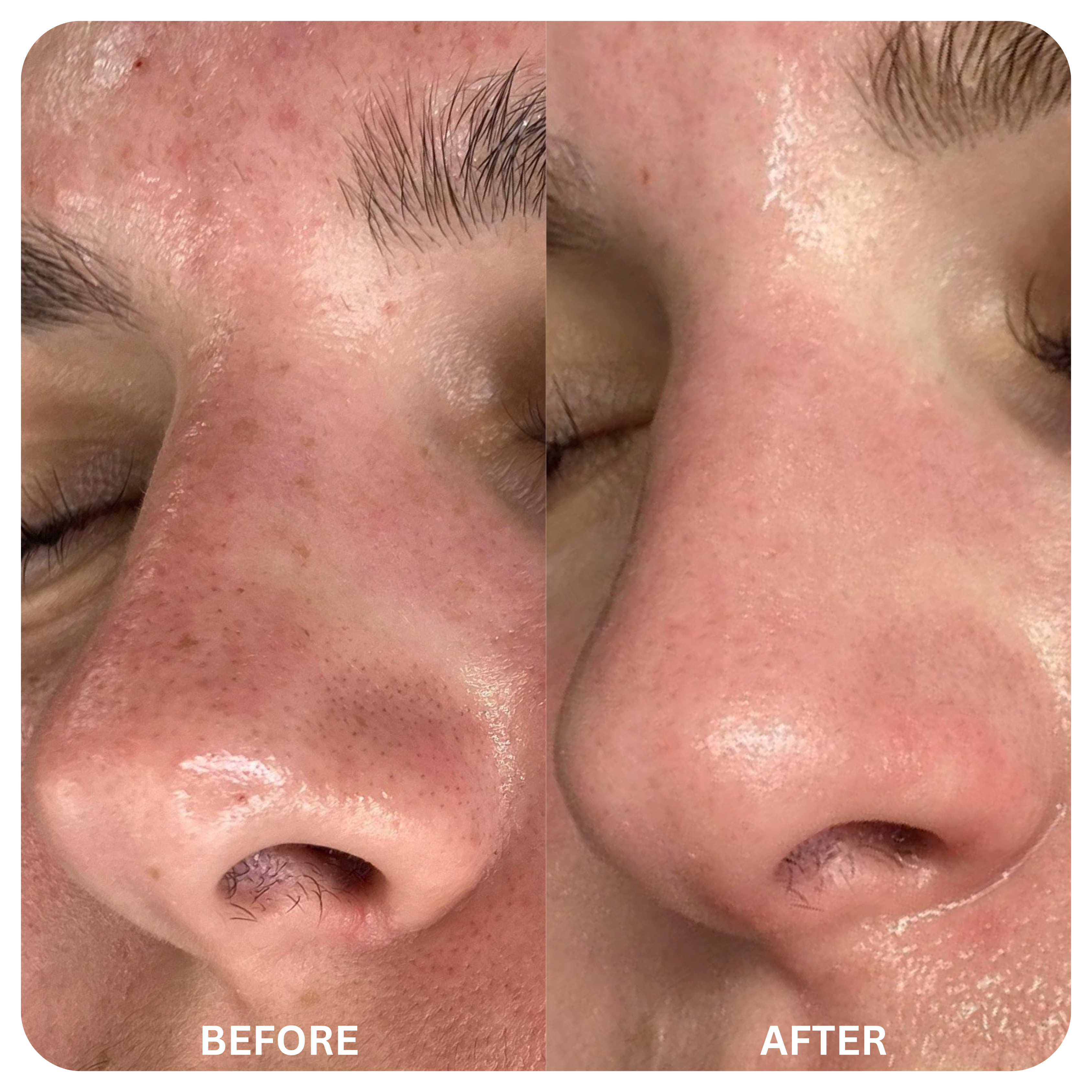 Blackhead Remover Mask + 60 Sheets