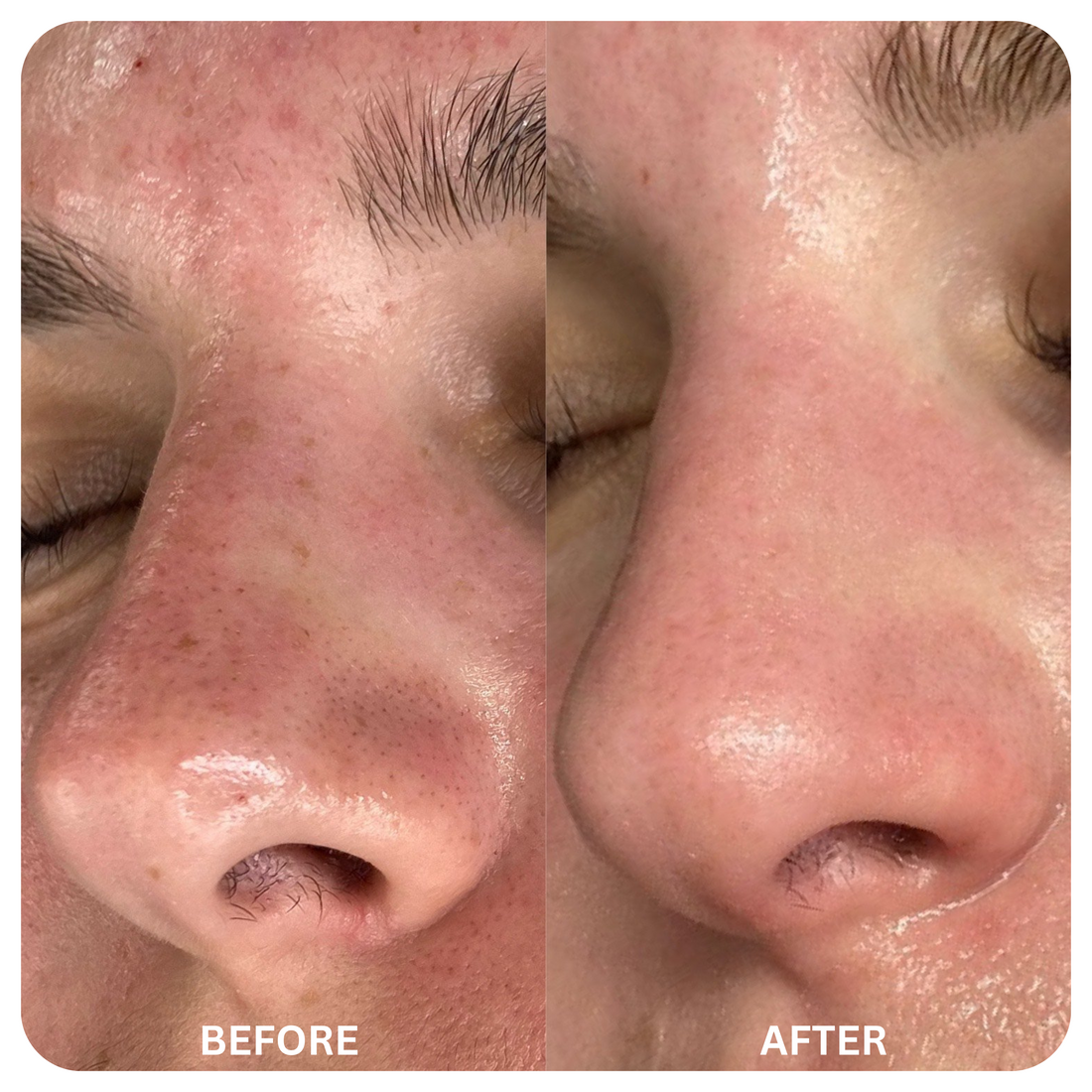 Blackhead Remover Mask + 60 Sheets