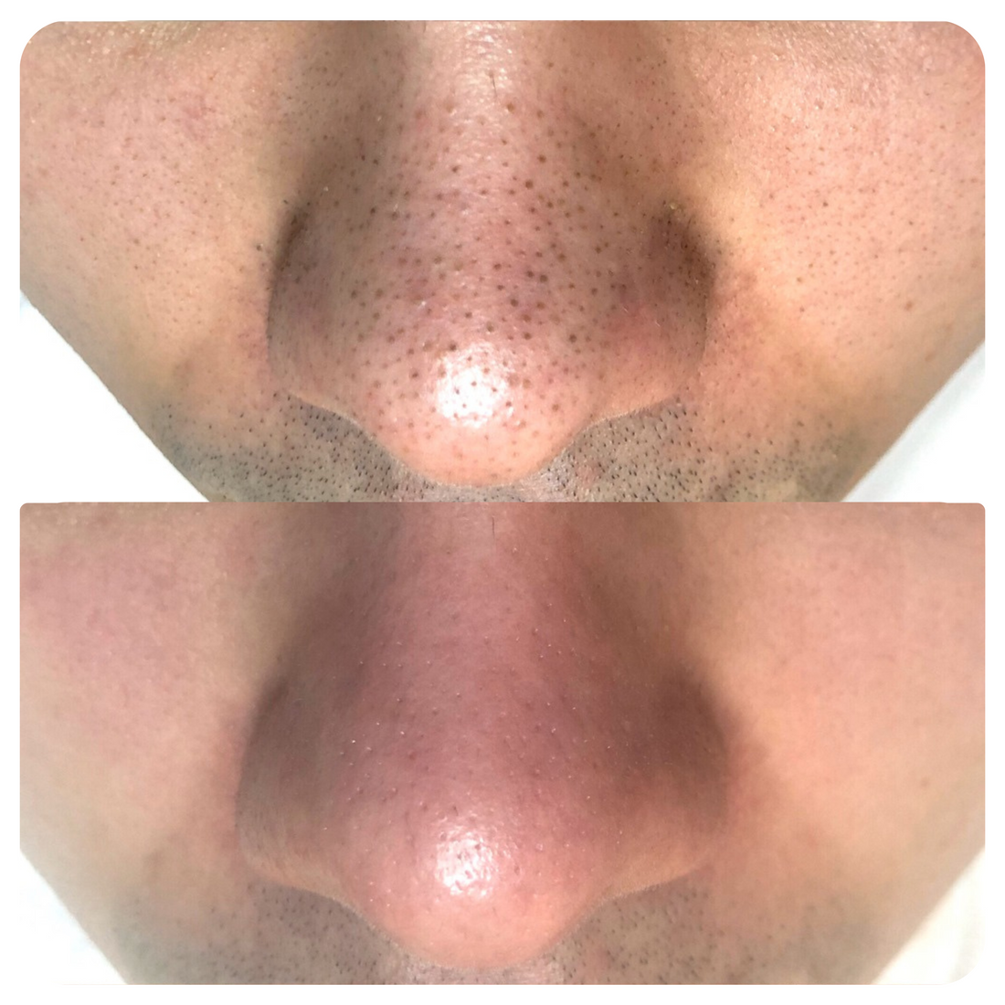 Blackhead Remover Mask + 60 Sheets