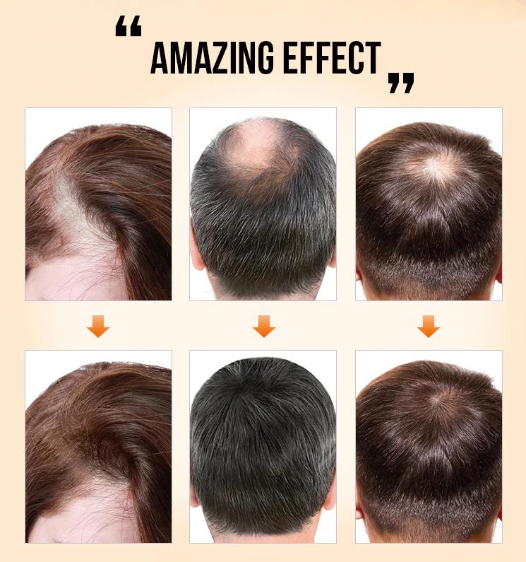 Hair Treatment For Hair Growth & Anti Hair Loss